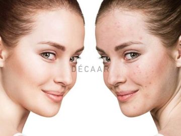 #Serum B5 Có Trị Mụn Không? Tại Sao Dùng Serum B5 Bị Nổi Mụn?