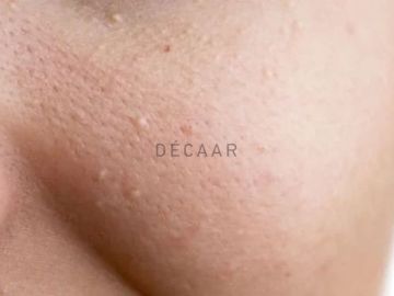 #Top 5+ Cách Đẩy Mụn Ẩn Dưới Da Toàn, Không Gây Tổn Thương Da