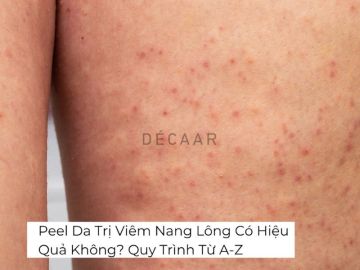 #Peel Da Trị Viêm Nang Có Hiệu Quả Không? Quy Trình Từ A-Z