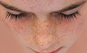 VÌ SAO ĐIỀU TRỊ SẠM PHẢI BẮT ĐẦU TỪ PHỤC HỒI HÀNG RÀO DA?