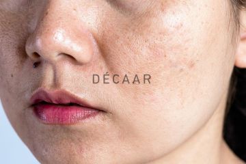 Peel Da Trị Nám 2026: Xu Hướng, Công Nghệ Và Phác Đồ Chuẩn Cho Spa