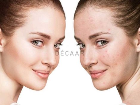 #Serum B5 Có Trị Mụn Không? Tại Sao Dùng Serum B5 Bị Nổi Mụn?