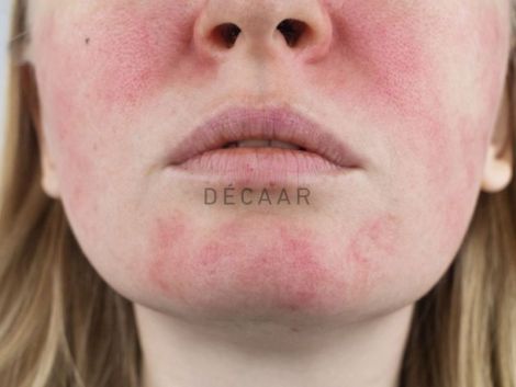 #Tác Dụng Phụ Của BHA: Nguyên Nhân Và Cách Giải Quyết