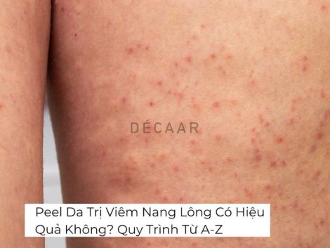 #Peel Da Trị Viêm Nang Có Hiệu Quả Không? Quy Trình Từ A-Z