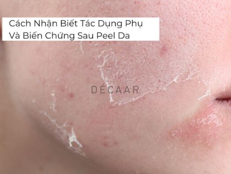 #Cách Nhận Biết Tác Dụng Phụ Và Biến Chứng Sau Peel Da