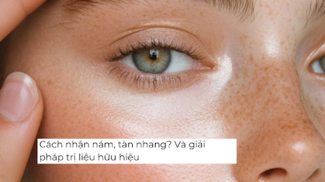 Cách nhận biết sắc tố do nắng khác với nám, tàn nhang