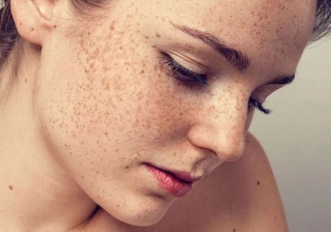 CHECKLIST PHÂN TÍCH DA CHUYÊN NGHIỆP TRƯỚC KHI ĐIỀU TRỊ NÁM