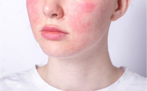 5 Sai Lầm Khiến Da Phục Hồi Mãi Không Tốt