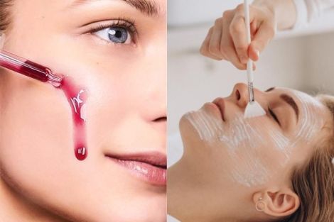 5 Công Nghệ Peel Da Mới Nhất Dành Cho Trị Nám Năm 2026