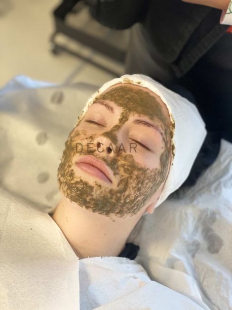 Peel da mụn? Lựa chọn sai lầm hay liệu pháp đúng đắn