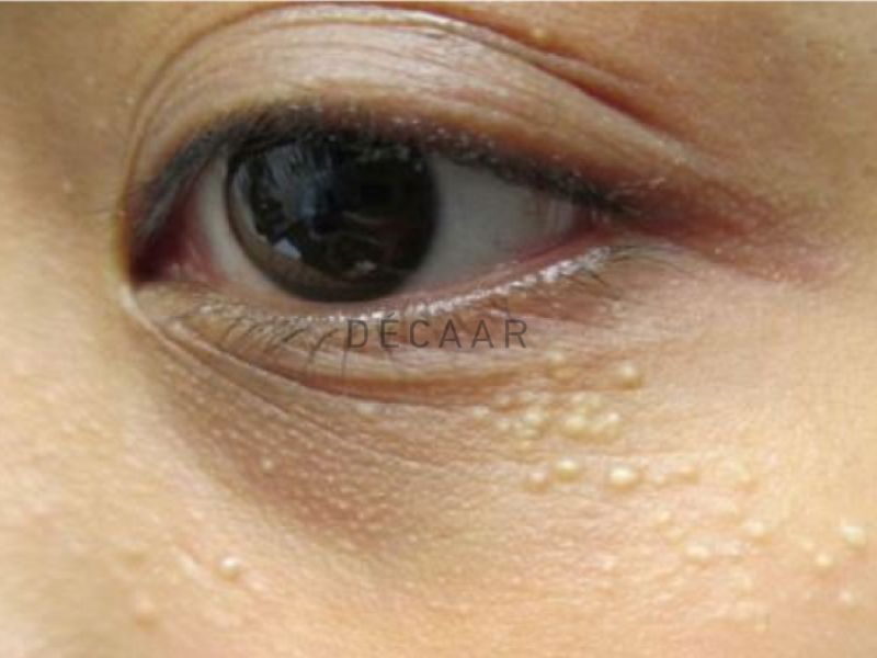 Dưới M&iacute; Mắt Nổi Mụn Trắng Nhỏ | C&aacute;ch Điều Trị Hiệu Quả