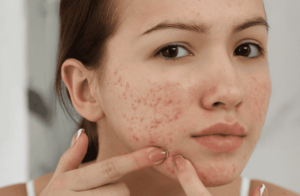 Cách trị mụn ẩn tại nhà an toàn | Vinmec