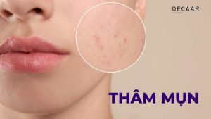 5+ Kem Trị Mụn Thâm Được Tin Dùng Nhiều Nhất Hiện Nay