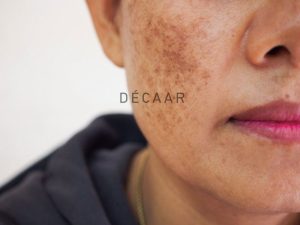Peel Da Có Trị Nám Được Không? Nên Peel Da Ở Đâu?