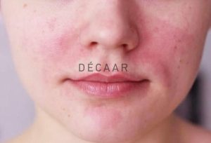 #Sau Khi Peel Da Bị Đỏ Rát - Cách Xử Lý Nhanh Chóng, An Toàn