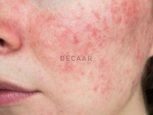 #Bí Quyết Chăm Sóc Da Sau Tái Tạo Hiệu Quả Nhất