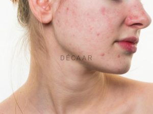 7+ Sản Phẩm Peel Da Cho Da Dầu Mụn Tốt Nhất