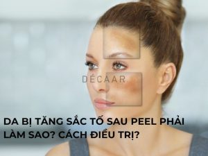 Da Bị Tăng Sắc Tố Sau Peel Phải Làm Sao? Cách Điều Trị