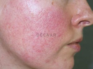 #Phục Hồi Da Mỏng Yếu Nổi Mạch Máu? Liệu Trình Điều Trị