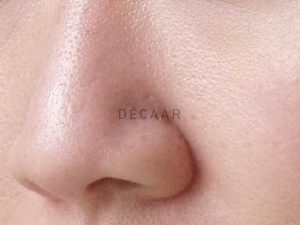 #Cách Chăm Sóc Da Dầu Mụn Lỗ Chân Lông To Từ Chuyên Gia