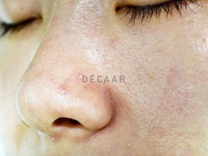 #Bộ Sản Phẩm Chăm Sóc Da Dầu Mụn Được Yêu Thích Nhất
