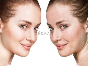#Serum B5 Có Trị Mụn Không? Tại Sao Dùng Serum B5 Bị Nổi Mụn?