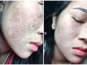 #Peel Da Bằng Rượu Thuốc Và Rủi Ro Tiềm Ẩn Nguy Hiểm
