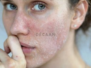 #Có Nên Peel Da Bằng Thuốc Bắc? Những Điều Bạn Cần Biết