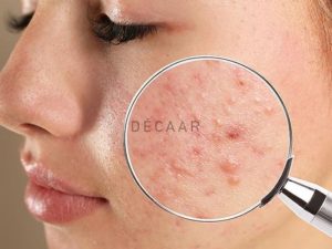 #Mụn Không Nhân Ở Má - Nguyên Nhân Và Cách Điều Trị
