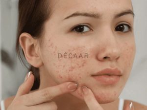 #Mụn Bọc Không Đầu Có Tự Xẹp Không?