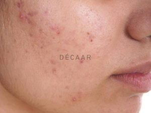 #Các Loại Mụn Viêm - Cách Nhân Biết Và Điều Trị