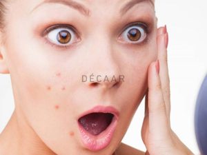 #Mụn Viêm Ở Má - Cách Điều Trị Và Chăm Sóc Từ A-Z