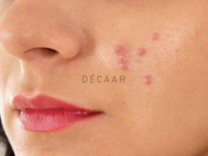 #Mụn Viêm Không Nhân Có Tự Hết Không?