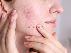 #Mụn Trứng Cá Viêm Là Gì? Cách Chăm Sóc Da Phòng Ngừa