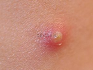 #Mụn Viêm Là Gì? Nguyên Nhân Và Cách Điều Trị Hiệu Quả