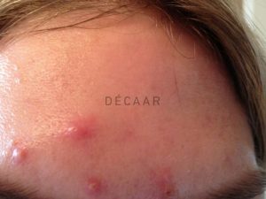 #Cách Trị Mụn Không Nhân An Toàn Và Nhanh Chóng