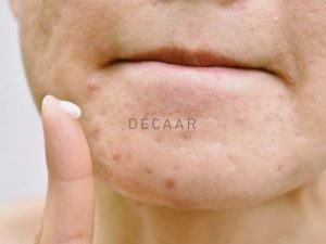 #Cách Trị Mụn Viêm Hiệu Quả Triệt Để, Không Gây Sẹo