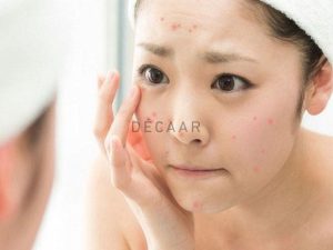 #Cách Trị Mụn Tuổi Dậy Thì An Toàn Và Nhanh Chóng