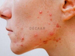 #Mụn Tuổi Dậy Thì - Nguyên Nhân Và Cách Phòng Ngừa