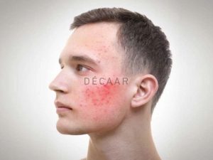 #Cách Trị Mụn Ở Tuổi Dậy Thì Cho Nam Chi Tiết Từ A-Z