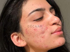 #Mụn Tuổi Dậy Thì Có Tự Hết Không? Kéo Dài Bao Lâu?