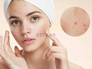 #Cách Trị Mụn Trứng Cá Tại Nhà Nhanh Chóng Hiệu Quả