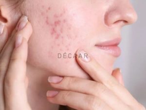 #Da Mặt Đột Nhiên Nổi Nhiều Mụn Do Đâu? Cách Điều Trị A-Z