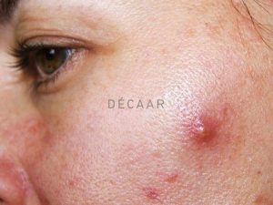 #Cách Trị Mụn Trứng Cá Nhanh Nhất Trong 1 Đêm