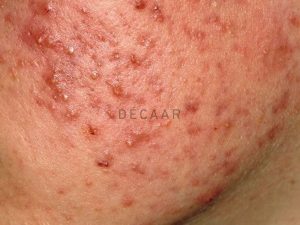 #Mụn Trứng Cá Nặng Có Nguy Hiểm Không?