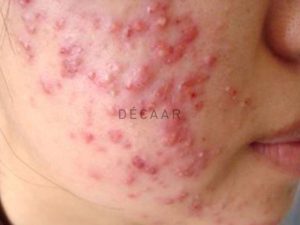 #Mụn Trứng Cá Mủ - Dấu Hiệu Và Cách Ngăn Ngừa Hiệu Quả