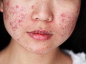 #Các Nguyên Nhân Gây Mụn Trứng Cá Bạn Cần Biết