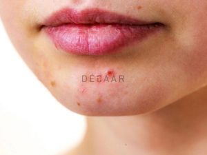 #Mụn Trứng Cá Ở Cằm: Dấu Hiệu Và Cách Chăm Sóc Da Tốt Hơn