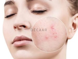 #Vị Trí Mọc Mụn Trên Khuôn Mặt Có Ảnh Hưởng Thế Nào?