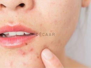 #Mụn Mọc Quanh Miệng Do Đâu? Cách Trị Mụn Nhanh Chóng, Hiệu Quả